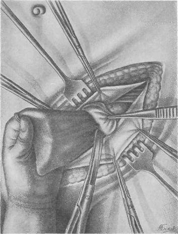 Хирургия грыж брюшной стенки - any2fbimgloader68.jpeg