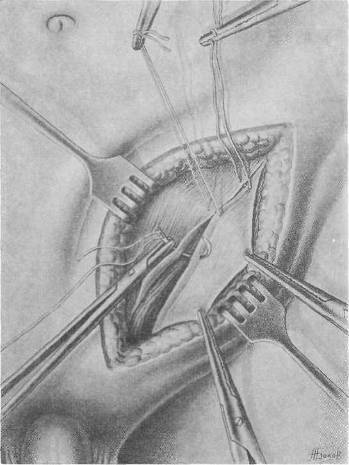 Хирургия грыж брюшной стенки - any2fbimgloader70.jpeg