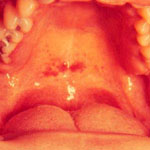 СПИД: приговор отменяется - mononucleosis_body.jpg