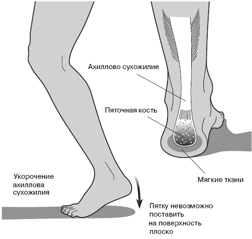 Все о здоровье ваших ног. От младенчества до старости - pic_12.png