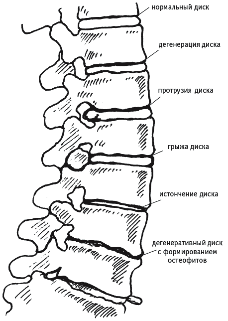 Как избавиться от боли в спине - _016.png