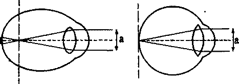 Можно ли жить без очков? - _0.png