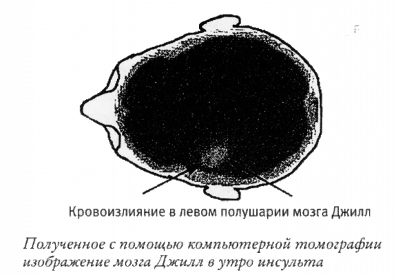 Мой инсульт был мне наукой. История собственной болезни, рассказанная нейробиологом - _121309.png