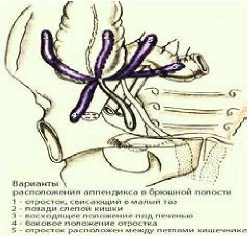 Оперативная хирургия аппендэктомии - b00000220.jpg