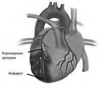 Инсульт, инфаркт, внезапная смерть. Теория сосудистых катастроф - i_003.jpg