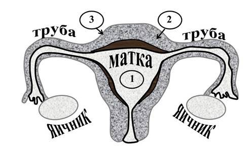 Миома матки – выход есть! - _1.jpg