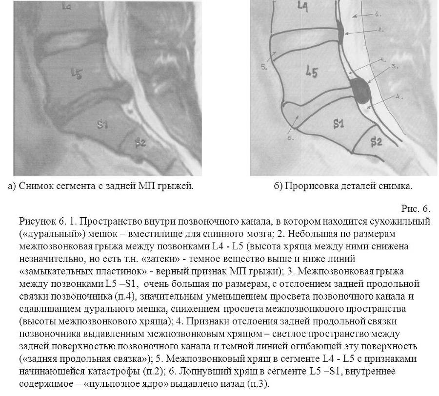 Межпозвонковая грыжа от "А" до "Я". Хрестоматия для «не» врачей, и не только… - _6.jpg