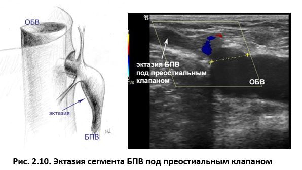 Ультразвуковая анатомия вен нижних конечностей - _2.10.jpg