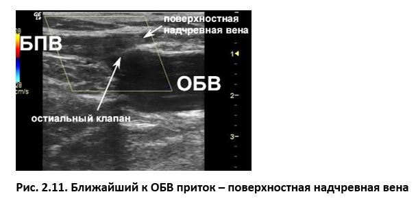 Ультразвуковая анатомия вен нижних конечностей - _2.11.jpg