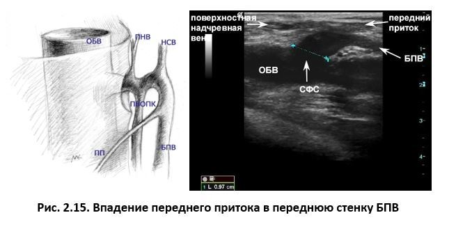 Ультразвуковая анатомия вен нижних конечностей - _2.15.jpg