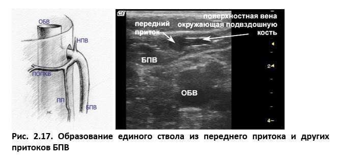 Ультразвуковая анатомия вен нижних конечностей - _2.17.jpg