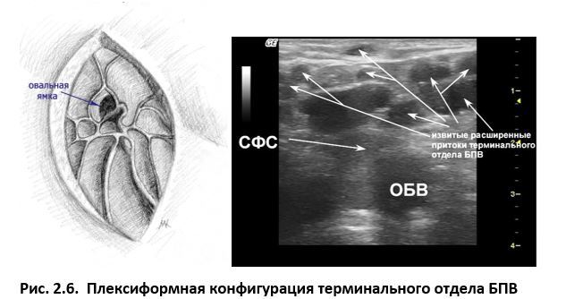 Ультразвуковая анатомия вен нижних конечностей - _2.6.jpg