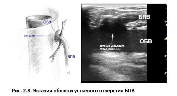 Ультразвуковая анатомия вен нижних конечностей - _2.8.jpg