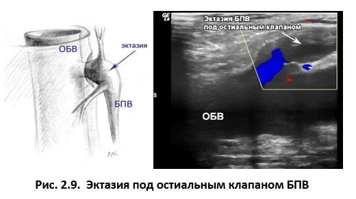 Ультразвуковая анатомия вен нижних конечностей - _2.9.jpg