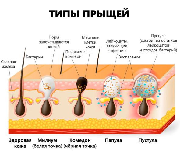 Как избавиться от прыщей и угрей раз и навсегда! Революционный, комплексный подход к устранению акне! - _4.jpg