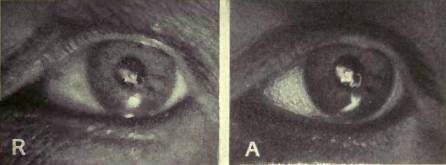 Лечение несовершенного зрения без помощи очков - _29.jpg