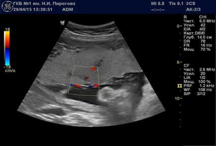 Эхографическая оценка структуры плаценты - i_007.jpg