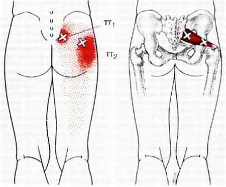 Миофасциальные боли и дисфункции. Руководство по триггерным точкам (в 2-х томах). Том 2. Нижние конечности - _00.jpg_10