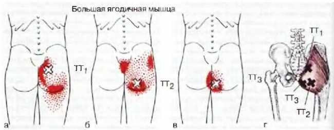 Миофасциальные боли и дисфункции. Руководство по триггерным точкам (в 2-х томах). Том 2. Нижние конечности - _00.jpg_6