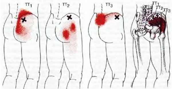 Миофасциальные боли и дисфункции. Руководство по триггерным точкам (в 2-х томах). Том 2. Нижние конечности - _00.jpg_8