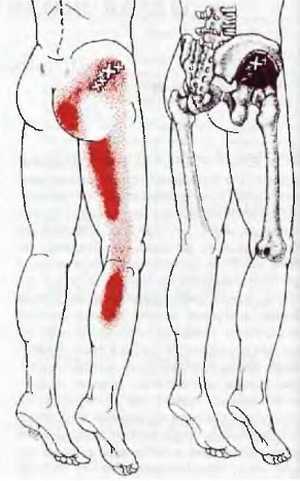 Миофасциальные боли и дисфункции. Руководство по триггерным точкам (в 2-х томах). Том 2. Нижние конечности - _01.jpg_8