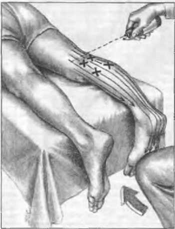 Миофасциальные боли и дисфункции. Руководство по триггерным точкам (в 2-х томах). Том 2. Нижние конечности - _03.jpg_19