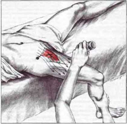 Миофасциальные боли и дисфункции. Руководство по триггерным точкам (в 2-х томах). Том 2. Нижние конечности - _05.jpg_10