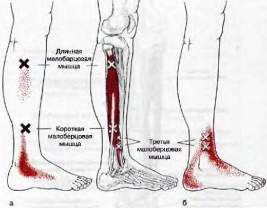 Миофасциальные боли и дисфункции. Руководство по триггерным точкам (в 2-х томах). Том 2. Нижние конечности - _05.jpg_14