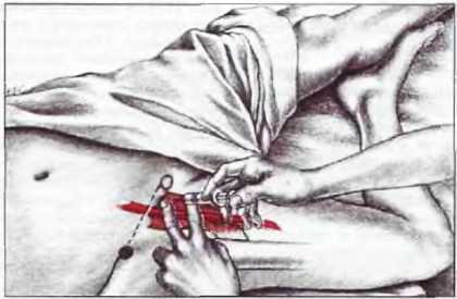 Миофасциальные боли и дисфункции. Руководство по триггерным точкам (в 2-х томах). Том 2. Нижние конечности - _06.jpg_8