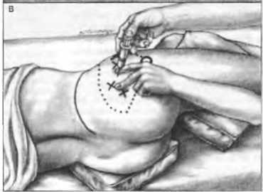 Миофасциальные боли и дисфункции. Руководство по триггерным точкам (в 2-х томах). Том 2. Нижние конечности - _08.jpg_2