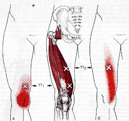 Миофасциальные боли и дисфункции. Руководство по триггерным точкам (в 2-х томах). Том 2. Нижние конечности - _08.jpg_4