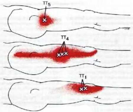 Миофасциальные боли и дисфункции. Руководство по триггерным точкам (в 2-х томах). Том 2. Нижние конечности - _10.jpg_2