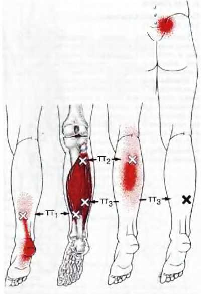 Миофасциальные боли и дисфункции. Руководство по триггерным точкам (в 2-х томах). Том 2. Нижние конечности - _10.jpg_7