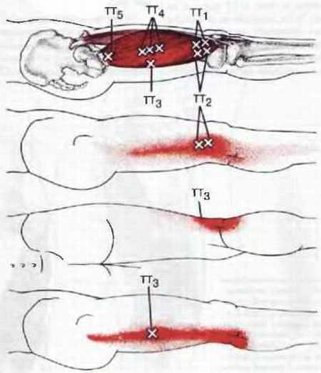 Миофасциальные боли и дисфункции. Руководство по триггерным точкам (в 2-х томах). Том 2. Нижние конечности - _11.jpg_2