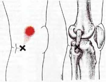 Миофасциальные боли и дисфункции. Руководство по триггерным точкам (в 2-х томах). Том 2. Нижние конечности - _12.jpg_1
