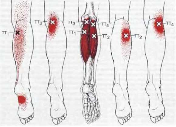 Миофасциальные боли и дисфункции. Руководство по триггерным точкам (в 2-х томах). Том 2. Нижние конечности - _12.jpg_4