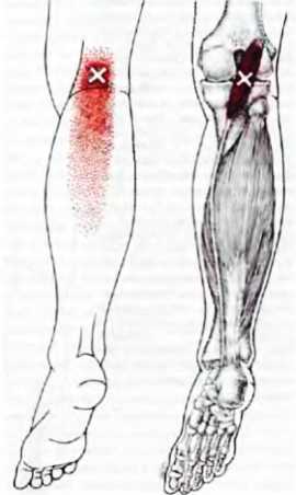 Миофасциальные боли и дисфункции. Руководство по триггерным точкам (в 2-х томах). Том 2. Нижние конечности - _12.jpg_5