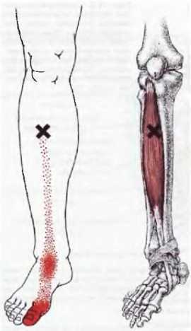 Миофасциальные боли и дисфункции. Руководство по триггерным точкам (в 2-х томах). Том 2. Нижние конечности - _17.jpg_1