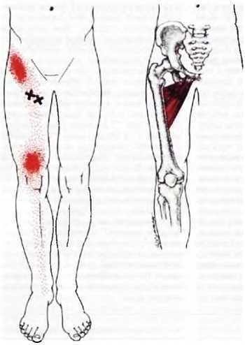 Миофасциальные боли и дисфункции. Руководство по триггерным точкам (в 2-х томах). Том 2. Нижние конечности - _27.jpg