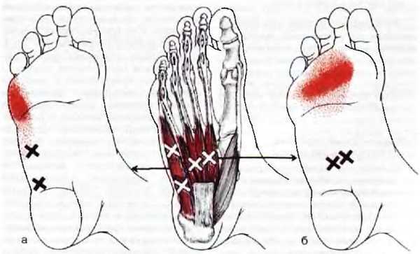 Миофасциальные боли и дисфункции. Руководство по триггерным точкам (в 2-х томах). Том 2. Нижние конечности - _02.jpg_22
