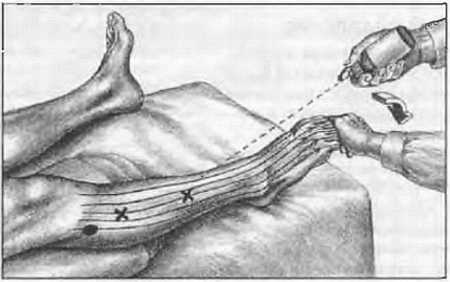 Миофасциальные боли и дисфункции. Руководство по триггерным точкам (в 2-х томах). Том 2. Нижние конечности - _06.jpg_16