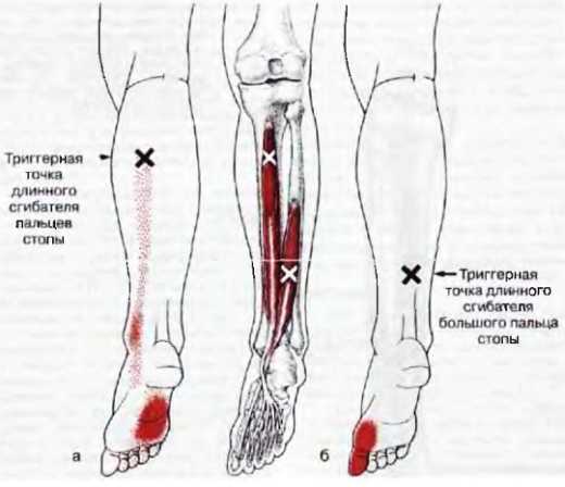 Миофасциальные боли и дисфункции. Руководство по триггерным точкам (в 2-х томах). Том 2. Нижние конечности - _08.jpg_11