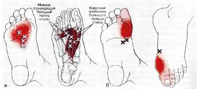 Миофасциальные боли и дисфункции. Руководство по триггерным точкам (в 2-х томах). Том 2. Нижние конечности - _10.jpg_10