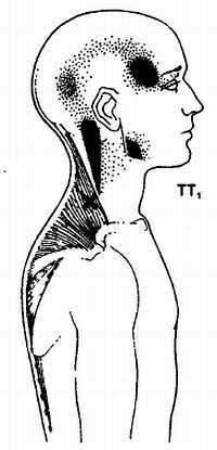 Миофасциальные боли и дисфункции. Руководство по триггерным точкам (в 2-х томах). Том 1. Верхняя половина туловища - _00.jpg_10