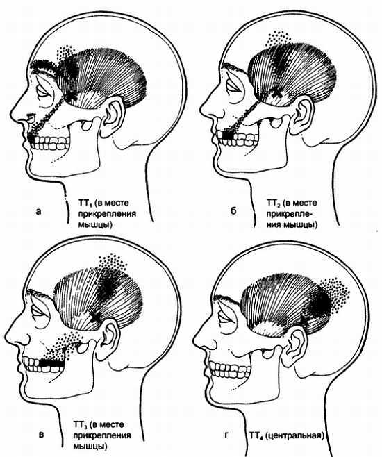 Миофасциальные боли и дисфункции. Руководство по триггерным точкам (в 2-х томах). Том 1. Верхняя половина туловища - _00.jpg_16