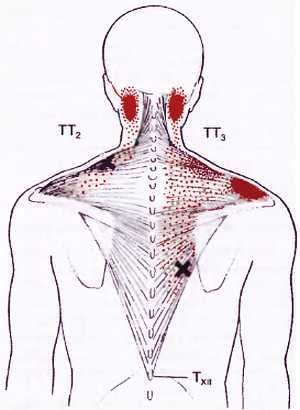 Миофасциальные боли и дисфункции. Руководство по триггерным точкам (в 2-х томах). Том 1. Верхняя половина туловища - _01.jpg_8