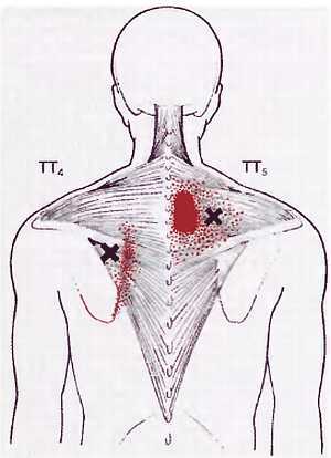 Миофасциальные боли и дисфункции. Руководство по триггерным точкам (в 2-х томах). Том 1. Верхняя половина туловища - _02.jpg_8