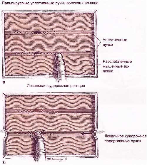 Миофасциальные боли и дисфункции. Руководство по триггерным точкам (в 2-х томах). Том 1. Верхняя половина туловища - _05.jpg_1