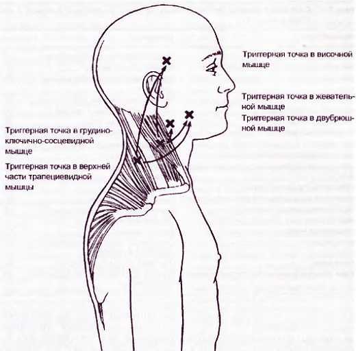 Миофасциальные боли и дисфункции. Руководство по триггерным точкам (в 2-х томах). Том 1. Верхняя половина туловища - _09.jpg_1