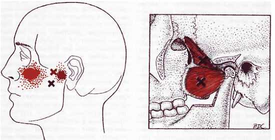 Миофасциальные боли и дисфункции. Руководство по триггерным точкам (в 2-х томах). Том 1. Верхняя половина туловища - _00.jpg_18